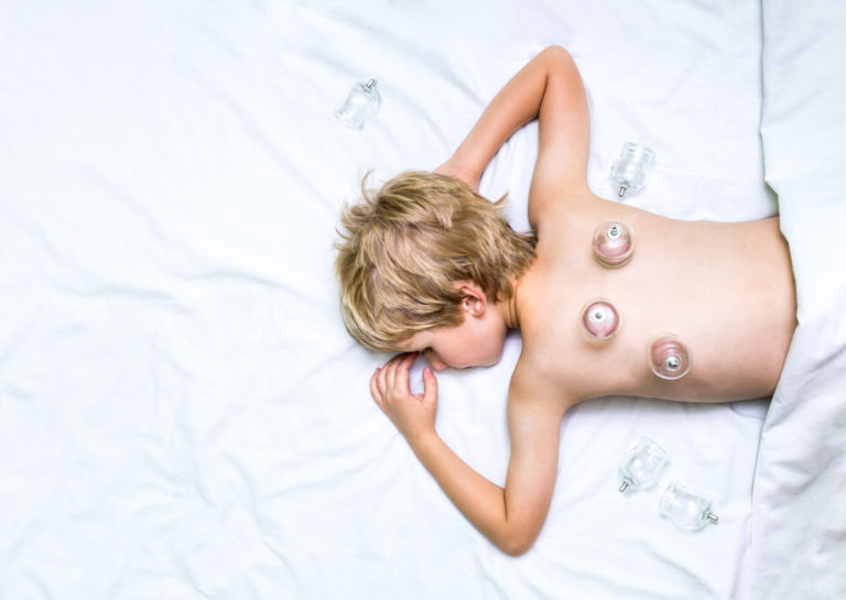 TCM Cupping For Kids In Singapore